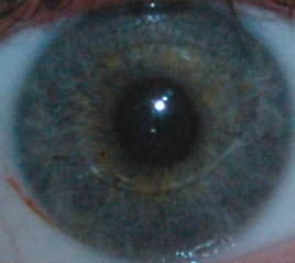 My eye with the Artiflex lens visible