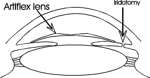 Artiflex Lens Diagram